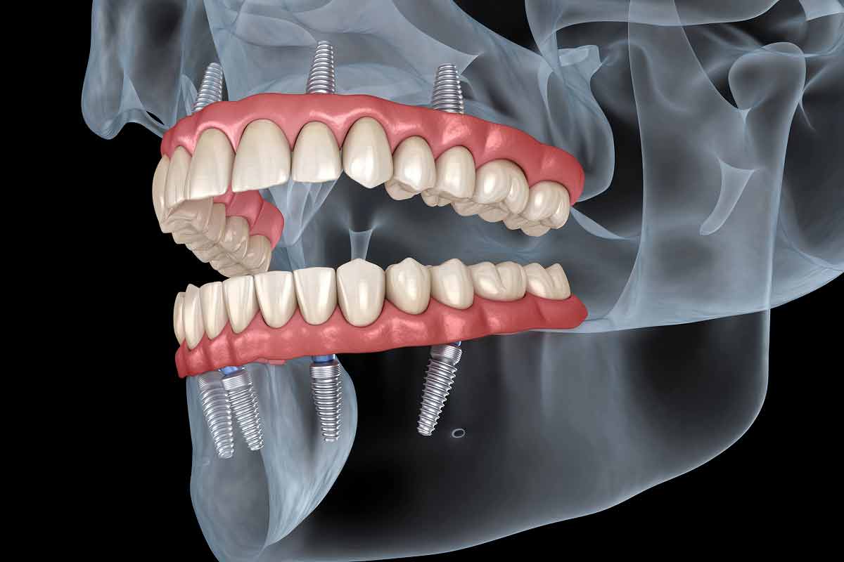 all-on-4 implants offered at Brodine Prosthodontics in Rochester, NY