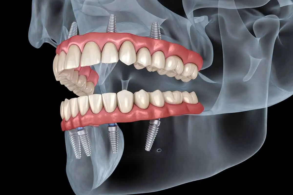 all-on-4 implants offered at Brodine Prosthodontics in Rochester, NY