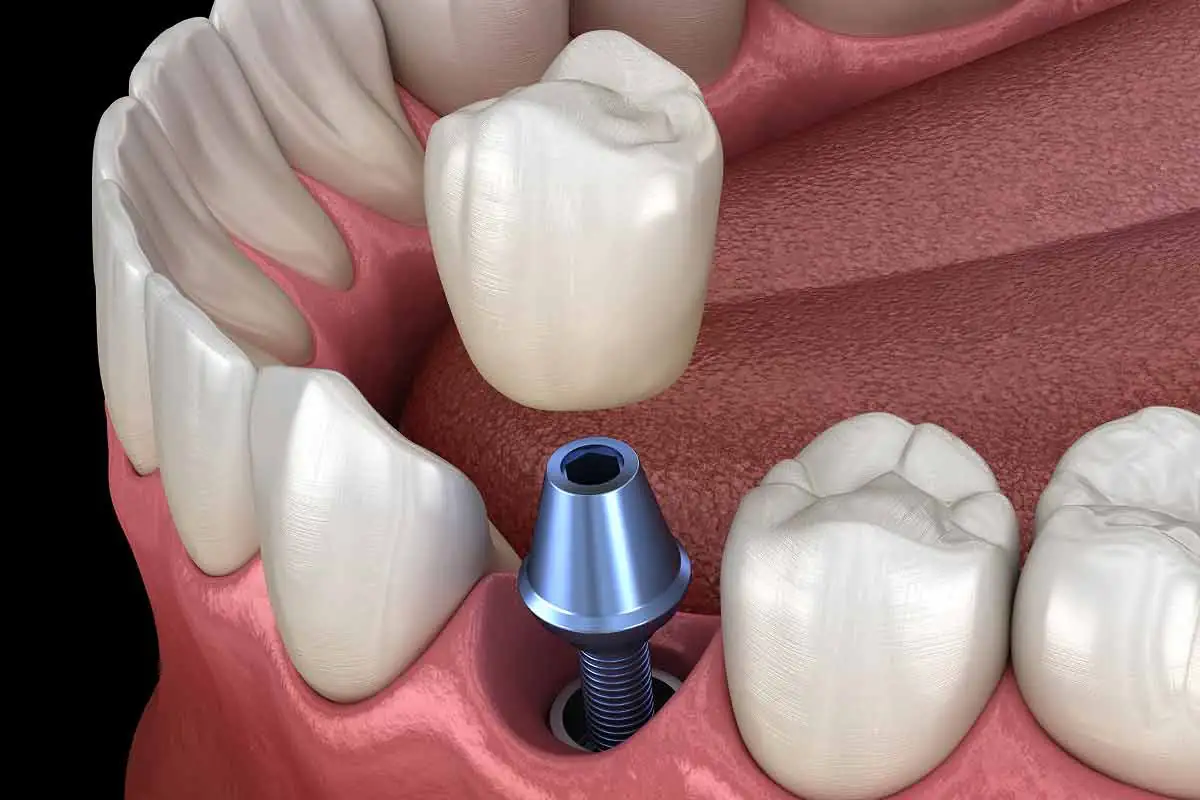 dental implant diagram