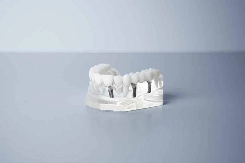 implant crowns & bridges Rochester NY