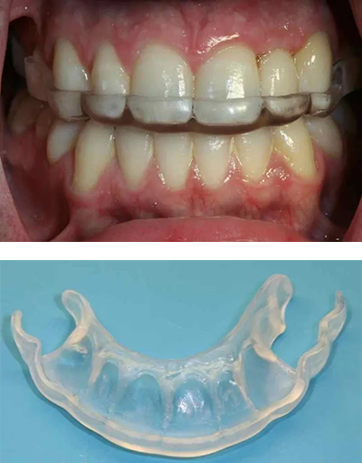 mouth guards for TMJ Rochester NY