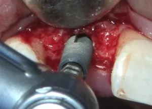 Image of doctor performing dental implant surgery