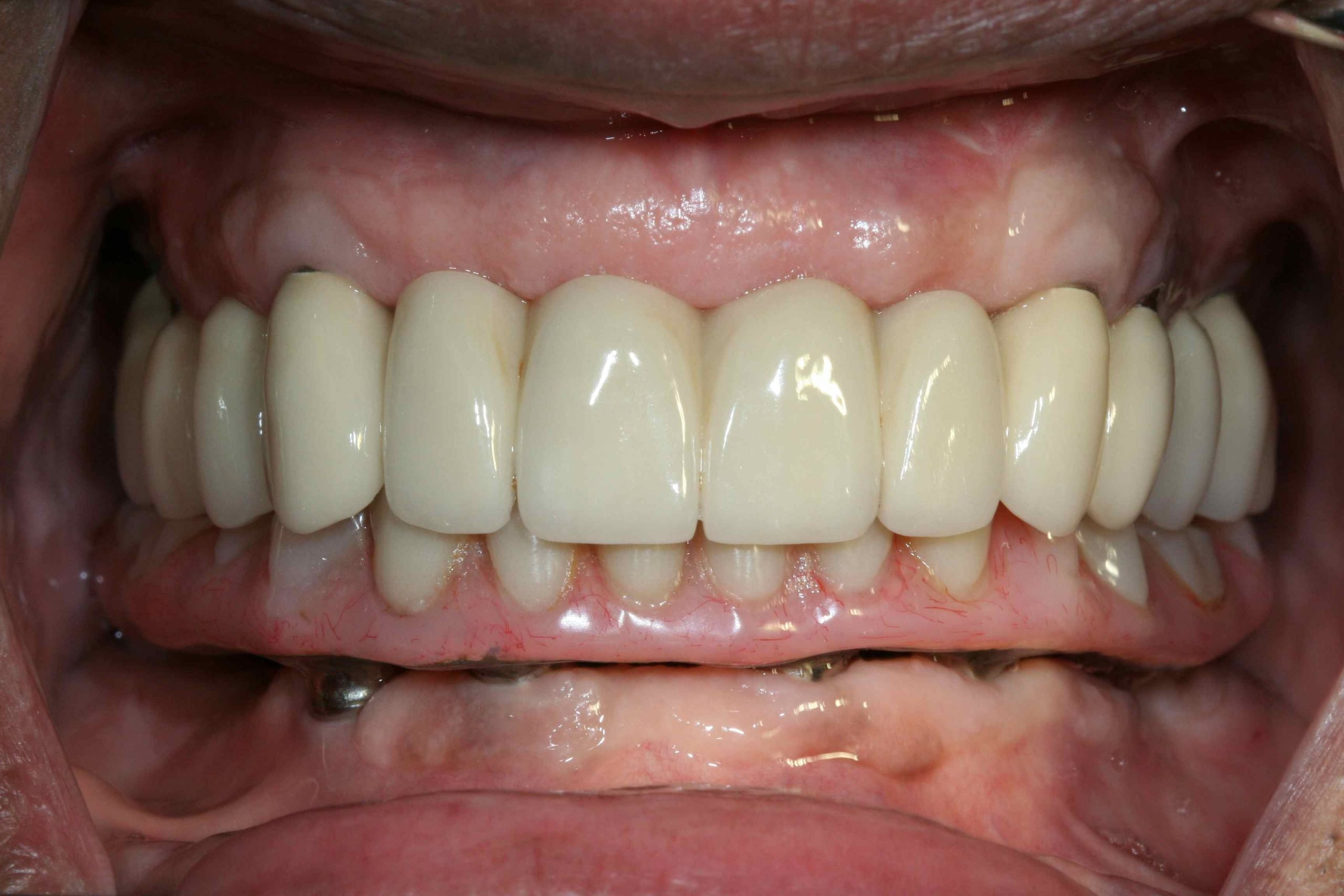 Full arch fixed implant, Prosthodontics Treatment Planning