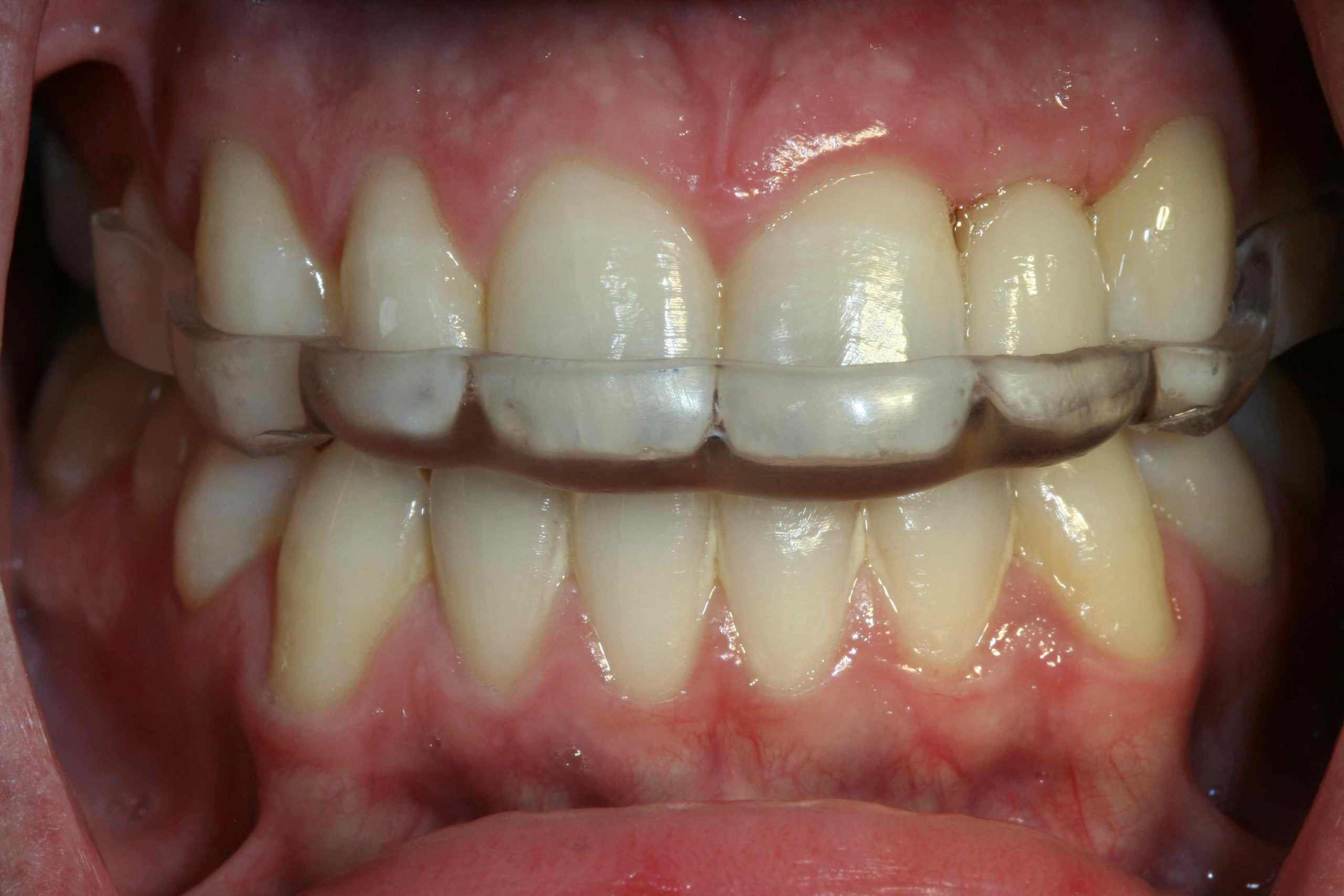 Hands on occlusion