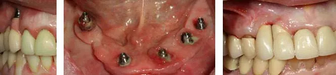 Dental Implants before and after photos