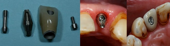 Implant restorative components