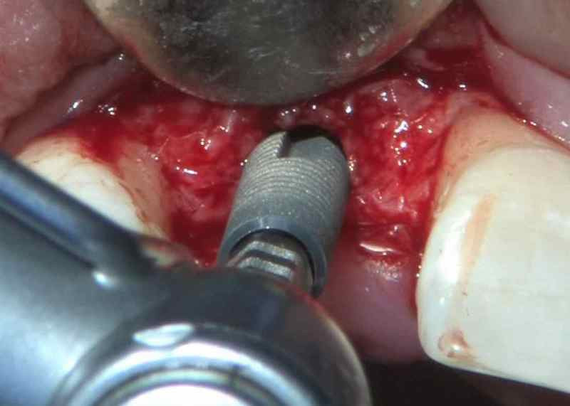 Image of implant being placed