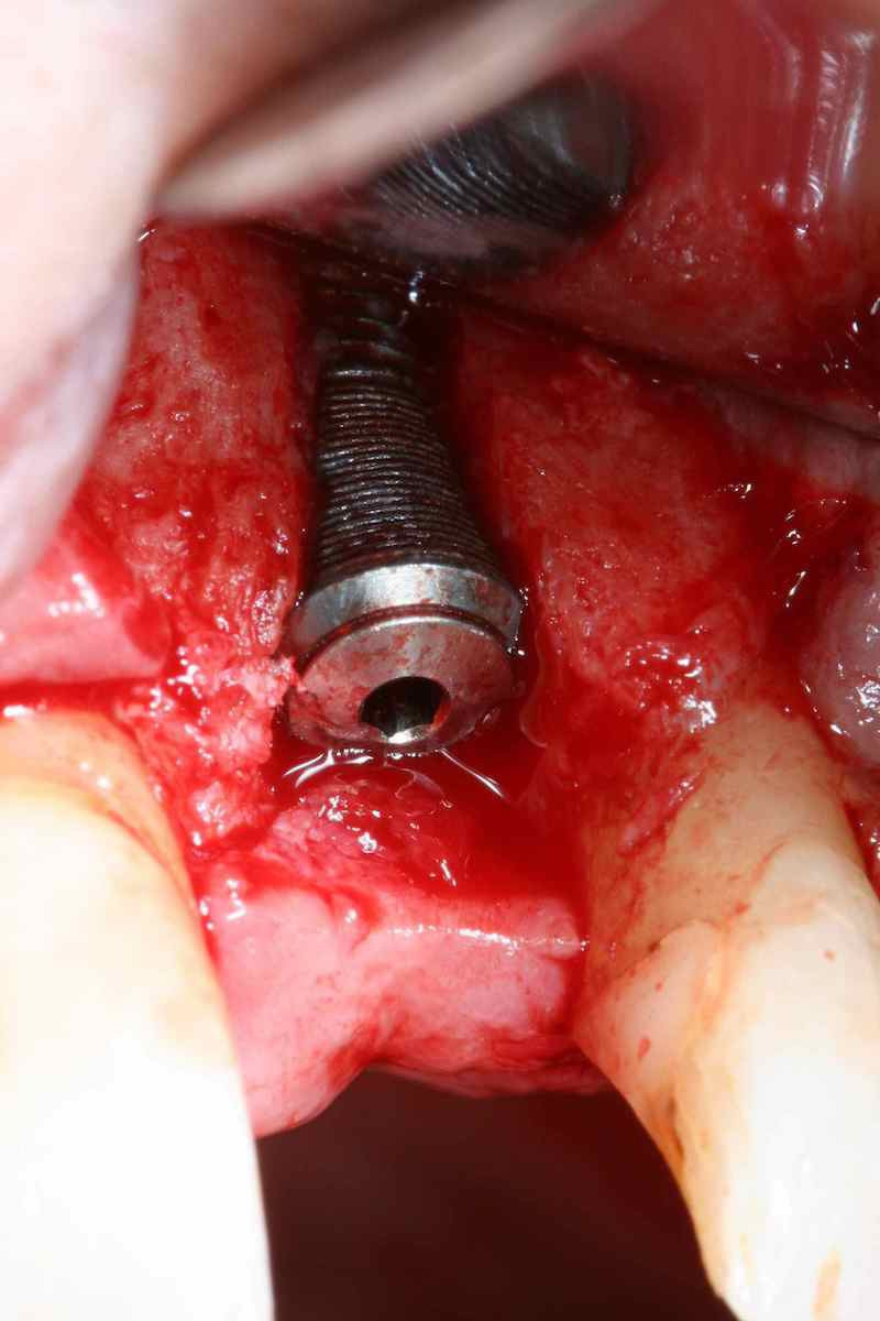 Image of dental implant with complication