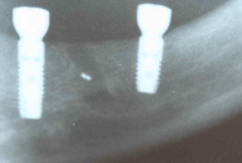 X-Ray of dental implants placement