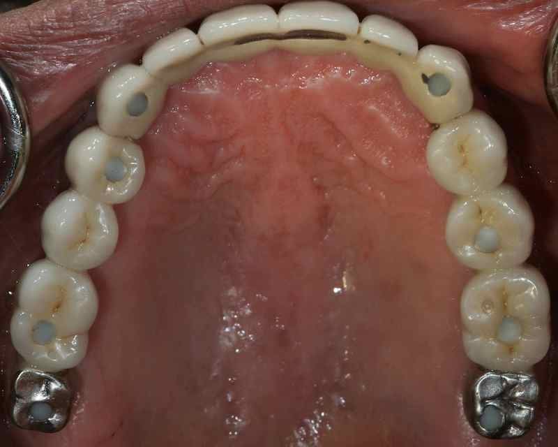 Screw-retained multi-unit implant prosthodontics