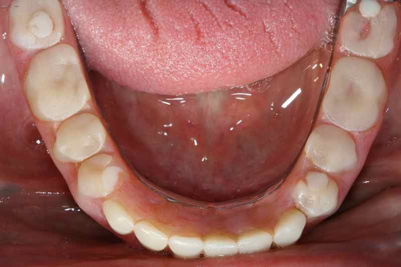 Screw-retained multi-unit implant prosthodontics