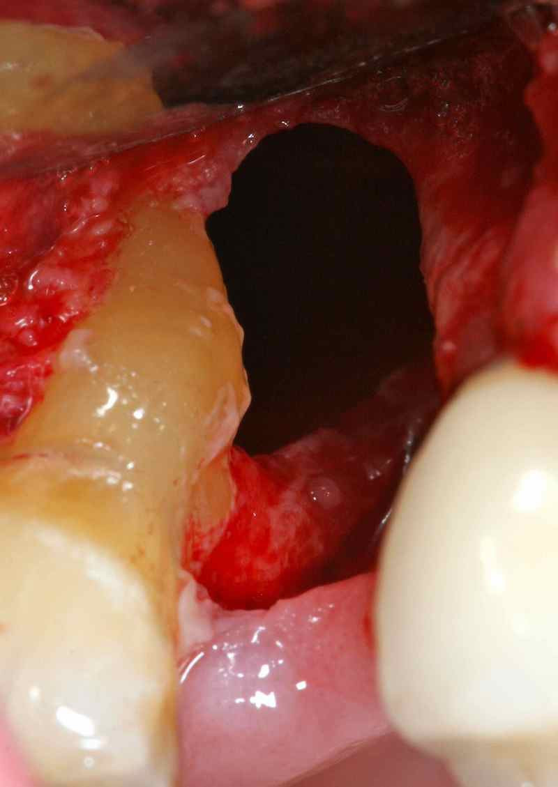 Dental Implant complication