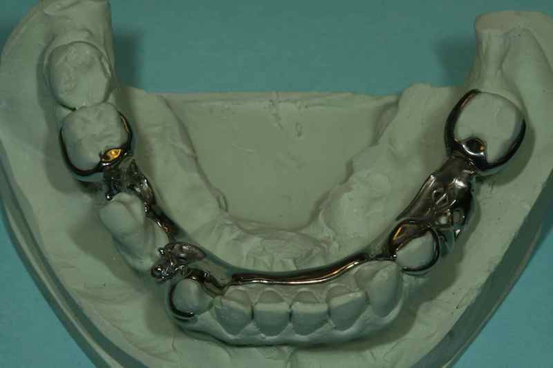 Removable Partial Dentures