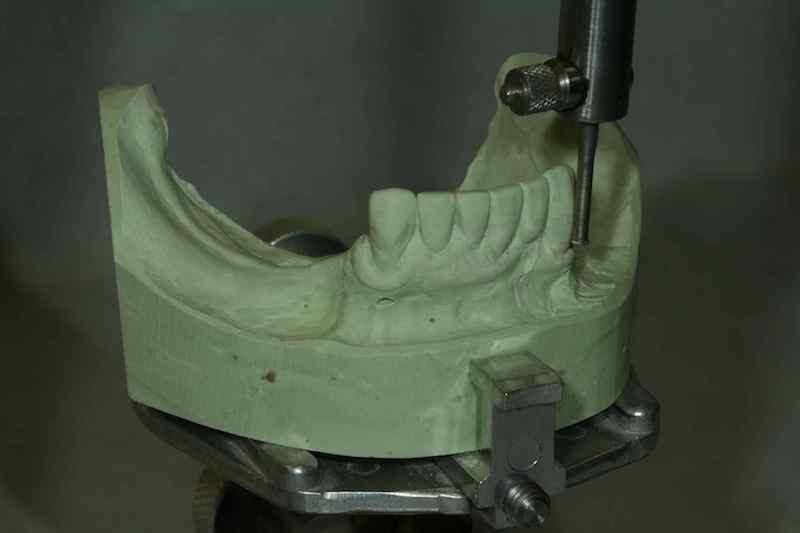 Removable Partial Dentures