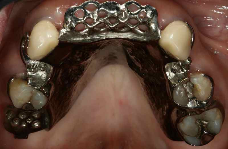 Removable Partial Dentures