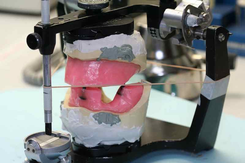 Complete Dentures and Teeth-in-Space