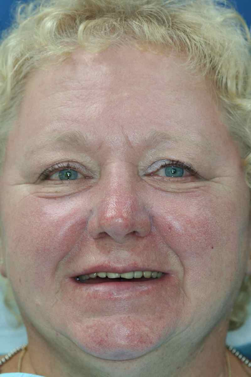 Patient before dentures and teeth-in-space