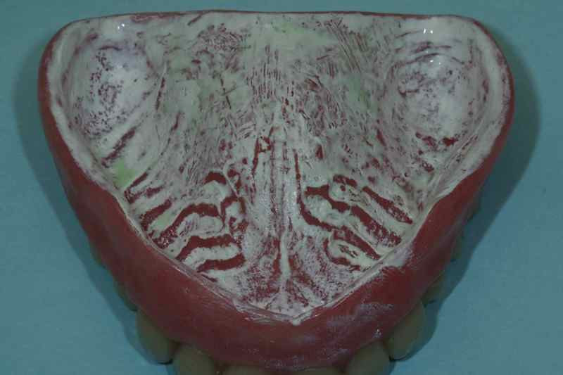 Complete Dentures and Teeth-in-Space