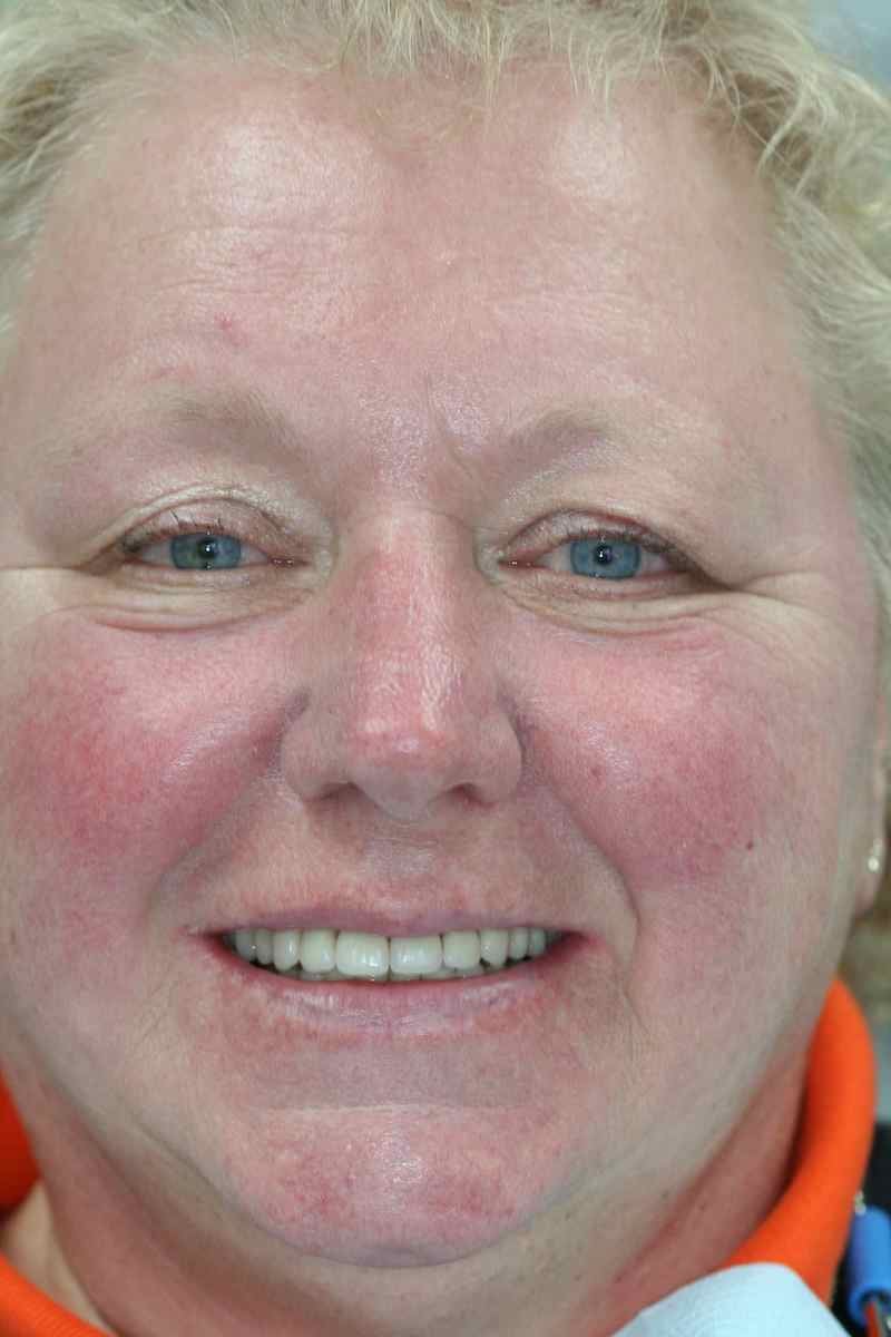 Patient before dentures and teeth-in-space