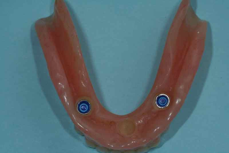 Dental Implant Over-dentures