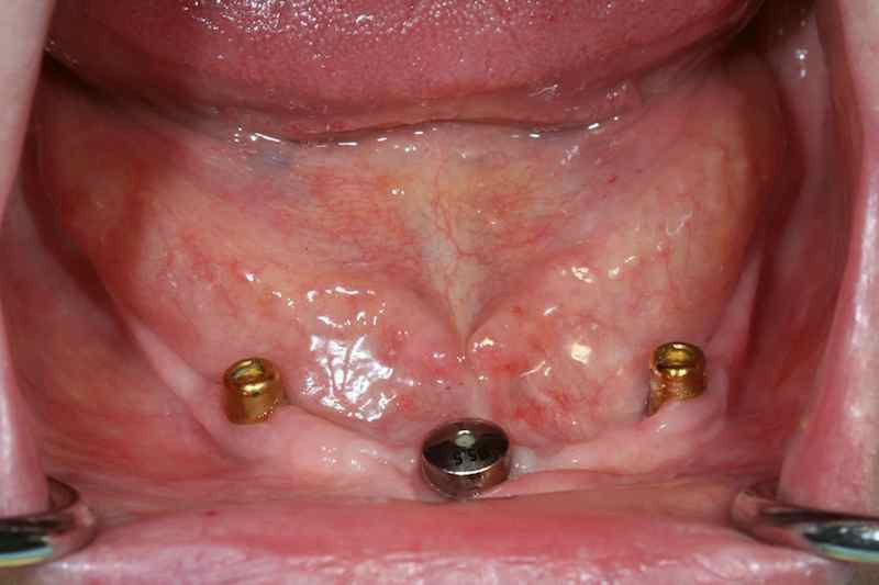 Dental Implant Over-dentures