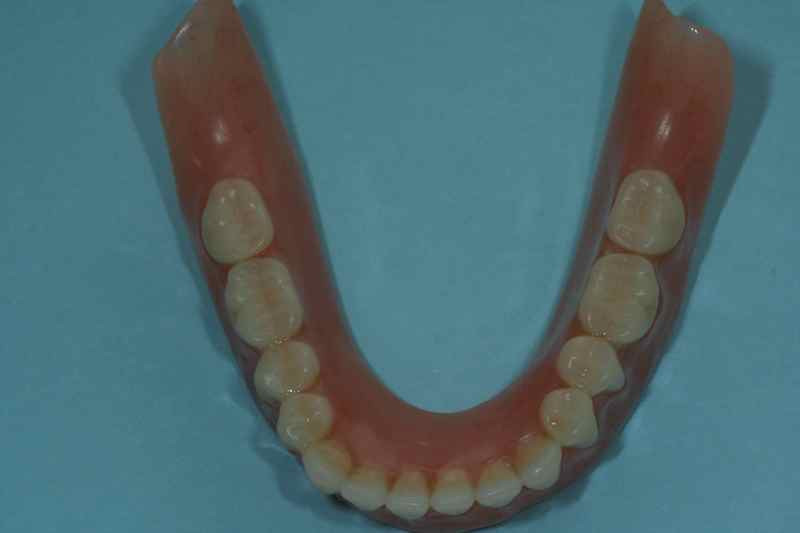 Dental Implant Over-dentures