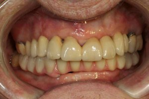 Full-arch implant surgery and full-arch implant prosthodontics
