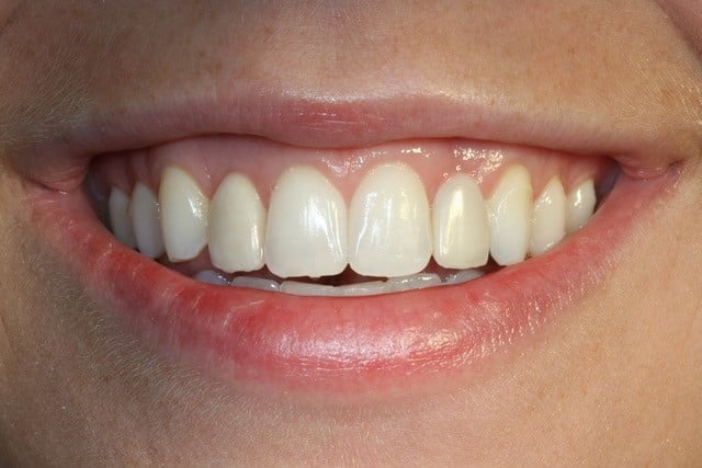 smiling woman with front top white teeth showing