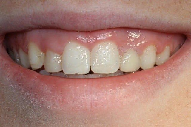 smiling woman with front teeth showing