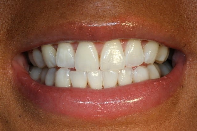 smiling woman full mouth teeth showing