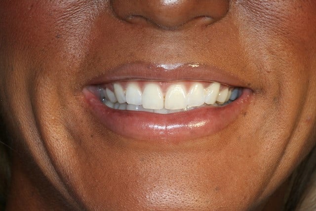 smiling woman top teeth showing