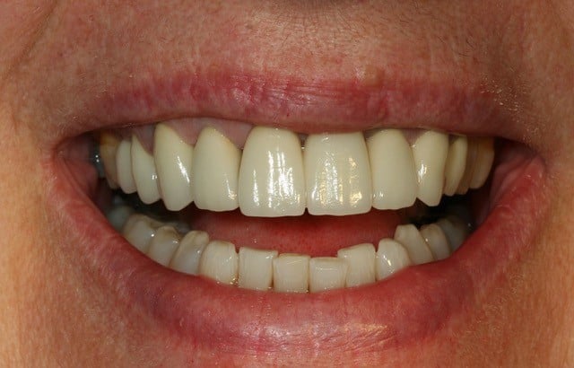 smiling woman with crooked bottom teeth