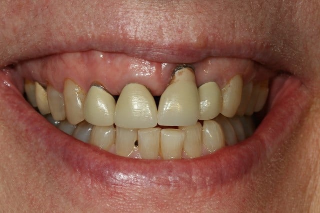 full mount smile of woman with a receding front tooth gum line