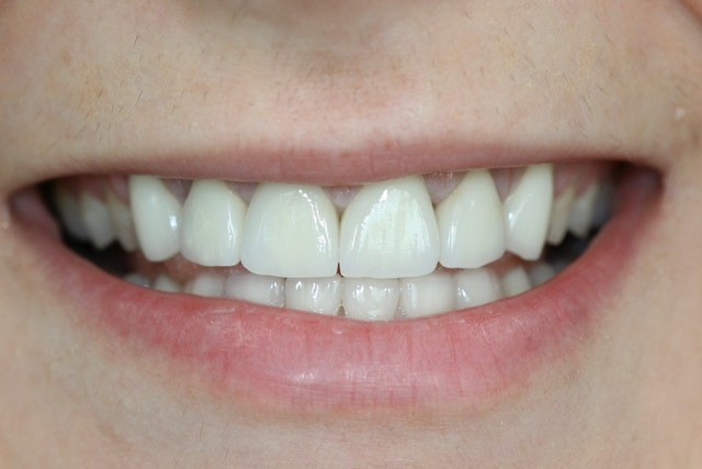 woman smiling for crown lengthening