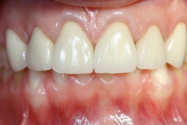 smiling woman before crown lengthening