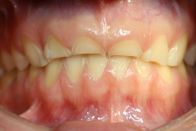 Crown lengthening
