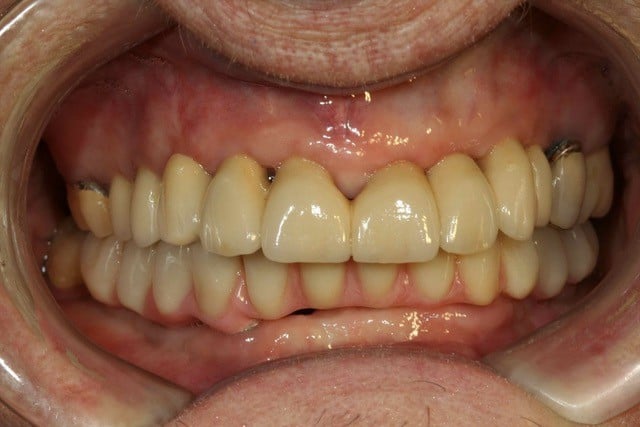 full mount smile of a man with yellow teeth