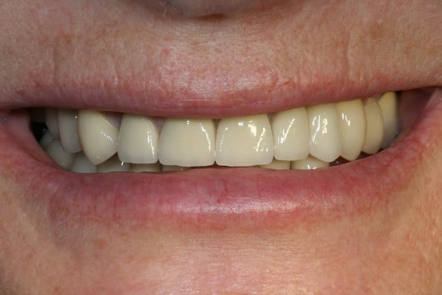smiling man upper teeth showing