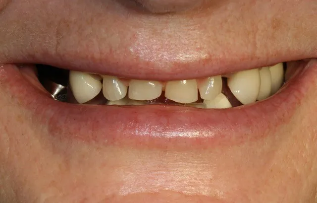 upper crocked teeth showing on a smiling man