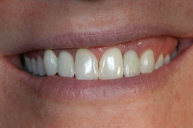 woman smiling front top teeth showing