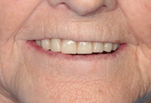 Before Upper Complete Denture and Lower Full-arch Implant Fixed Bridge