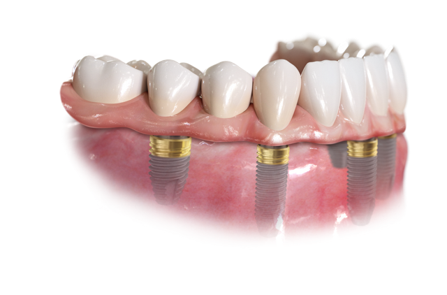 Arch Implant